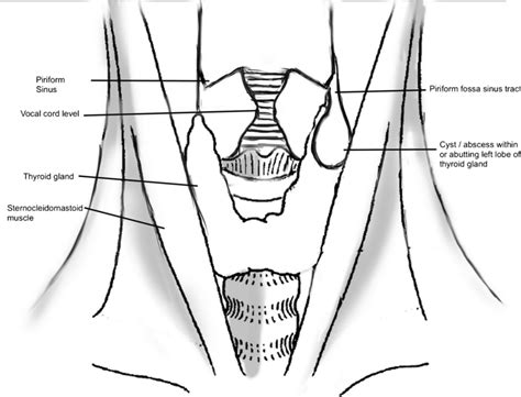 sinus piriformis|Piriform recess